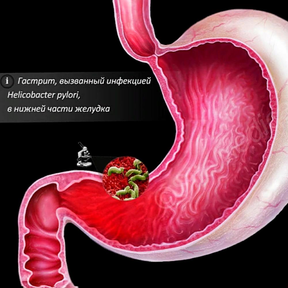 Гастрит передается через. Гастрит передается через. Язвенная болезнь желудка фгдс. Гастрит передается через. Фгдс при атрофическом гастрите.
