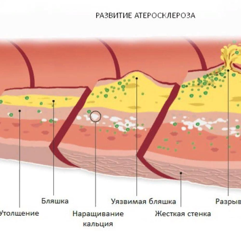 Холестериновые бляшки в сосудах