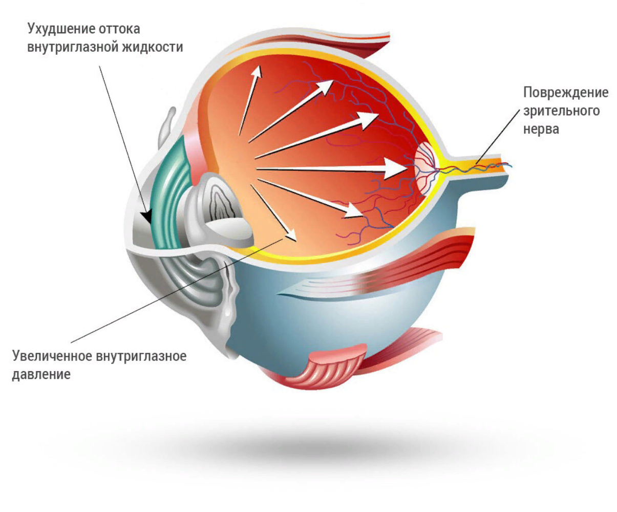 Что такое глаукома. Глаукома отток жидкости.