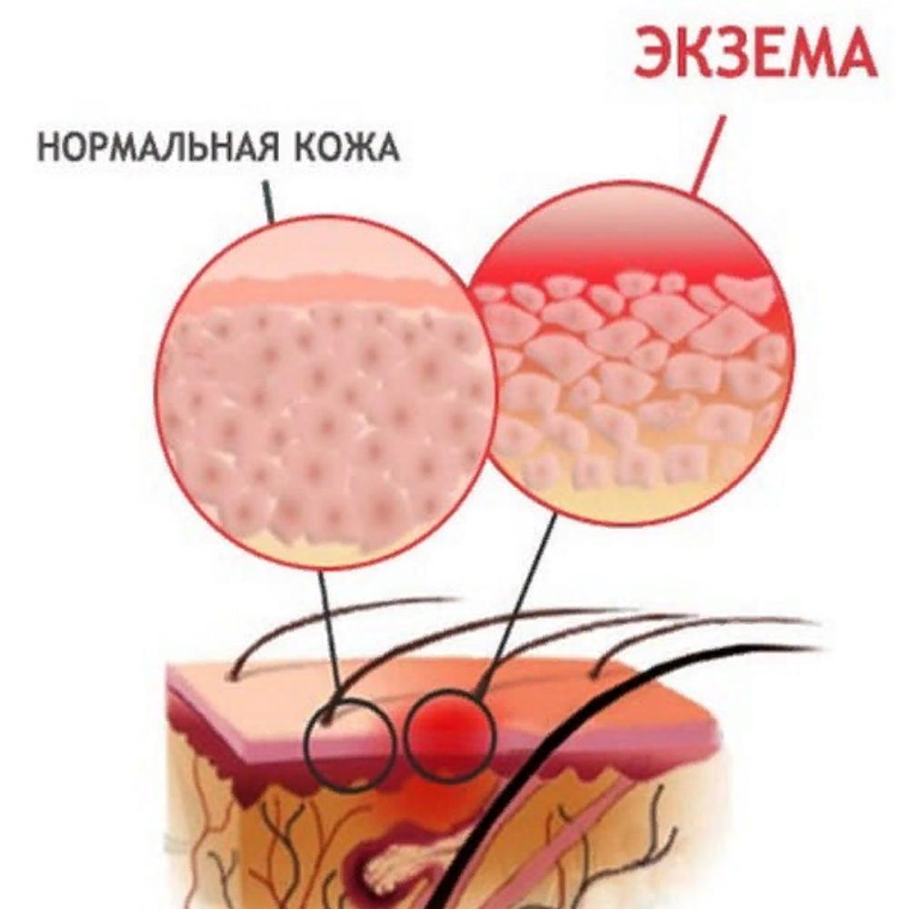 Кожные Заболевания И Их Признаки Картинки