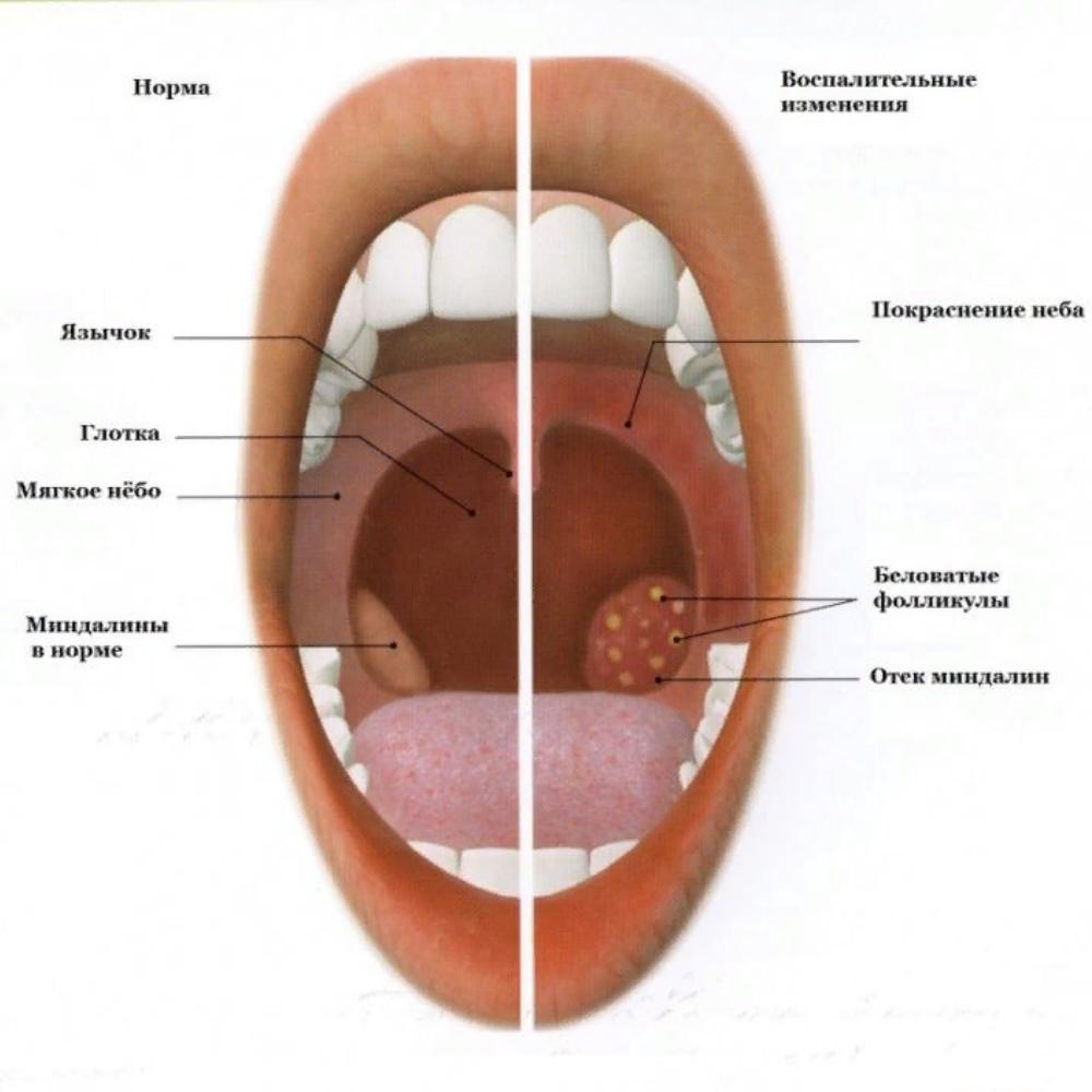 Беловатые Фолликулы На Миндалинах Фото Что Это